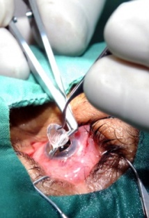 Fotos:Archivo Crece en Cuba tasa de donación de órganos por habitantes