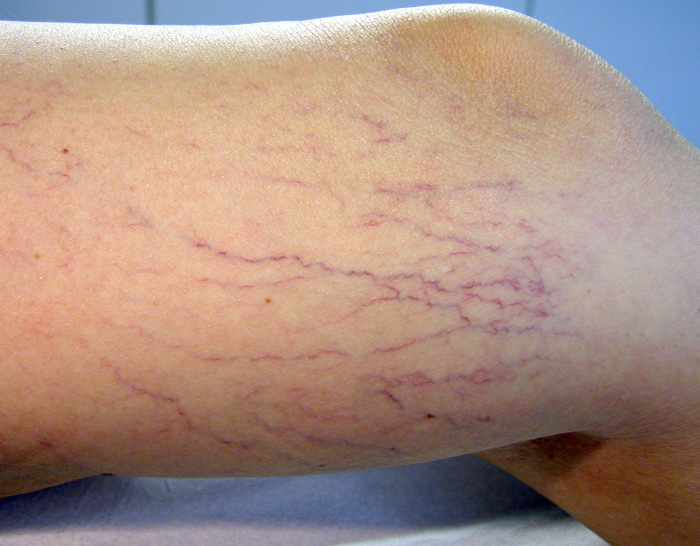 Foto: tomada de http://varicesmadrid.com/ Efectividad de tratamiento contra las várices en Camagüey