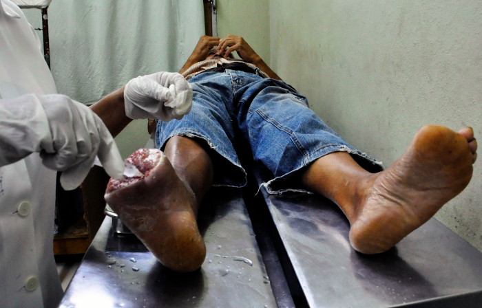 Foto:Otilio Rivero Delgado/Adelante/Archivo Camagüey resultados en uso del Heberprot P