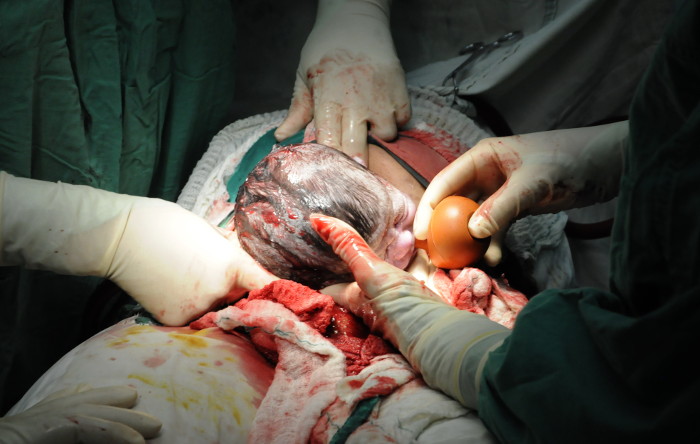 El parto pretérmino, aciertos y desaciertos de la cesárea  están entre las investigaciones a presentar. Foto: Otilio Rivero Delgado/ Adelante/ Archivo Con mirada de futuro Jornada de Ginecobstetricia