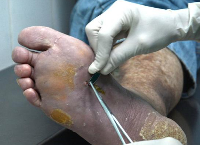 El Heberprot P ha demostrado los beneficios que reporta a los pacientes aquejados con pie diabético. Foto: Oscar Alfonso Soca/ACN El Heberprot-P beneficia a miles de pacientes en el orbe