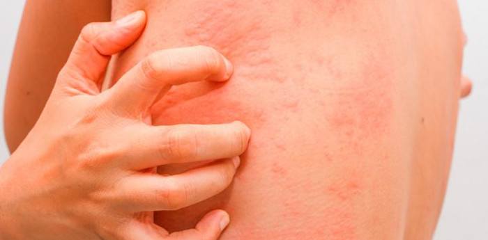 Photo:  Taken from webconsultas.com/ Half of Cuban youngsters suffer from allergies