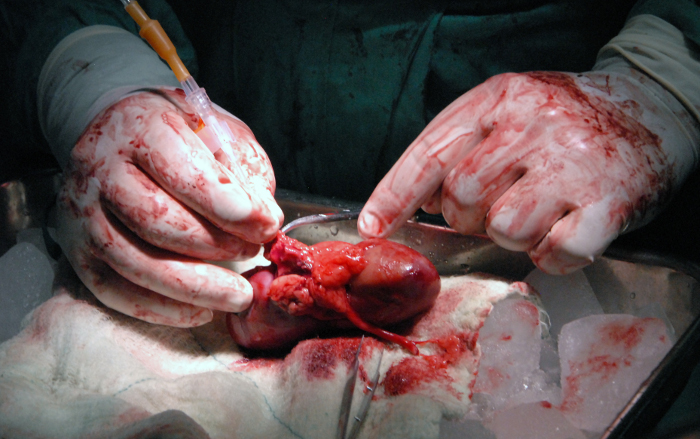 Cuban youngster gives father his kidney, transplant a success