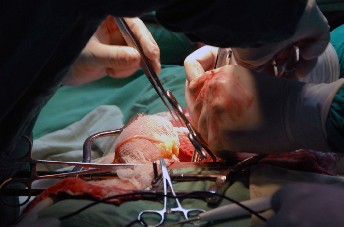 Bloqueo de Estados Unidos afecta al desarrollo de la Nefrología cubana