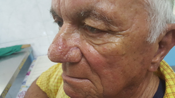 Enfermo de rosácea antes de recibir el tratamiento con críoterapia. Foto: De la autora