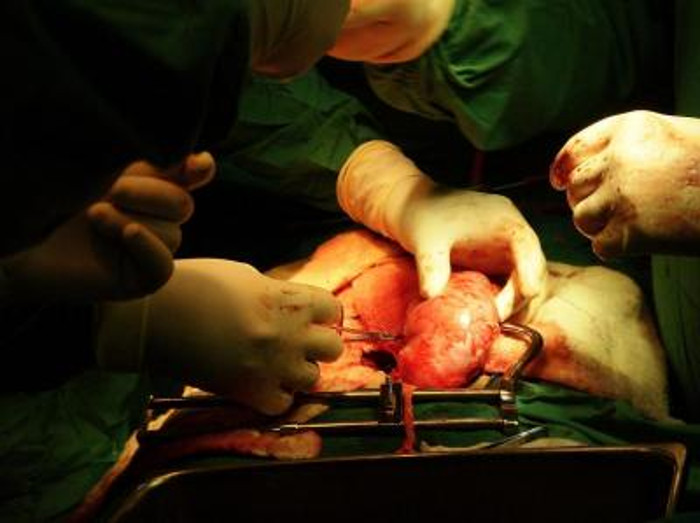 El riñón recobra su color de vida al ser conectado. La foto corresponde al trasplante de riñón número 500 en el "Manuel Ascunce". Foto: De la autora.