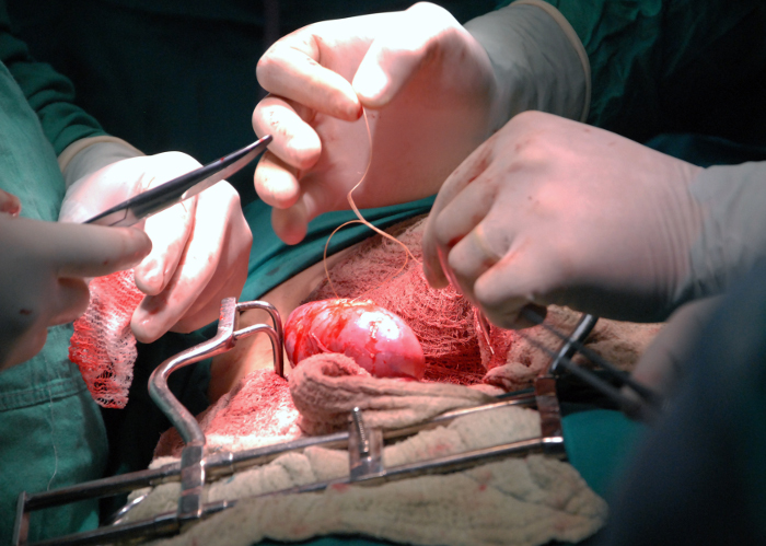 Primer autotrasplante de riñón del centro-oriente cubano