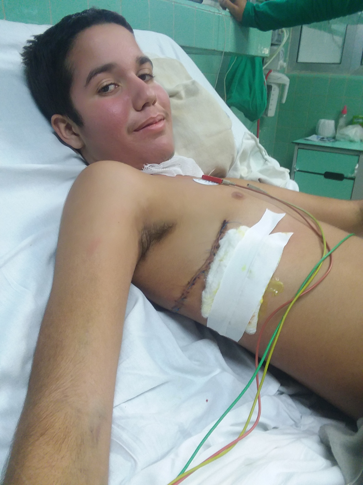 El paciente en su estado actual. Tomada después de retirarle las sondas torácicas. Cortesía del Dr. Ángel Pastor García.