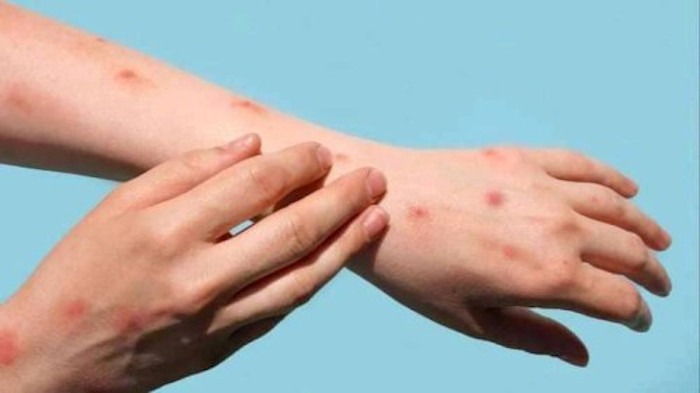 Foto: Tomada de tvartemisa.icrt.cu Cuba alerta ante viruela del mono